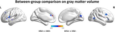 Neuroanatomical Changes Underlying Vertical HIV Infection in Adolescents